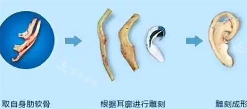 耳再造肋软骨雕刻成型的过程