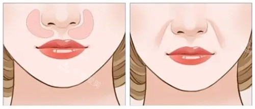 口周老化对面部影响