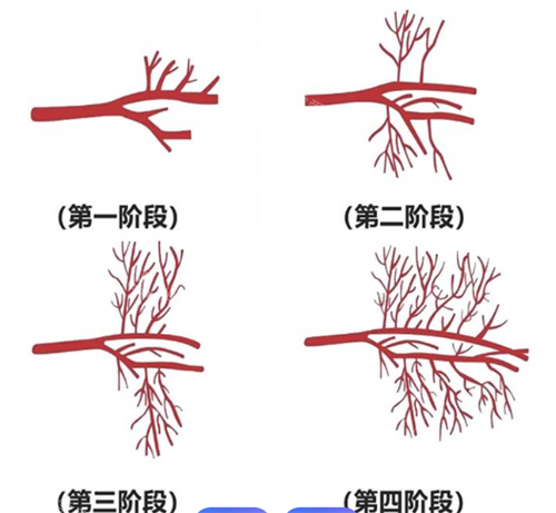 雷诺瓦治疗过程