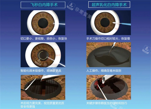 飞秒白内障手术过程图