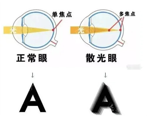 正常眼和散光眼的对比