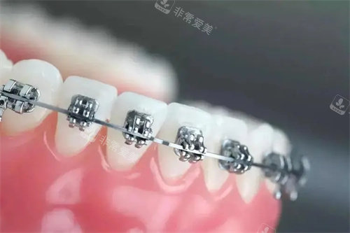 金属自锁托槽矫正