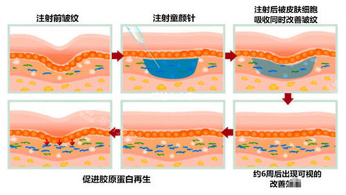 注射童颜针皮肤前后对比图