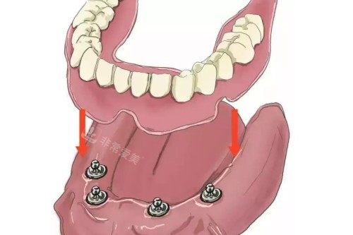 all-on-4种植模型预览图