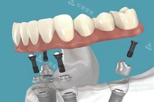 all-on-4种植卡通图