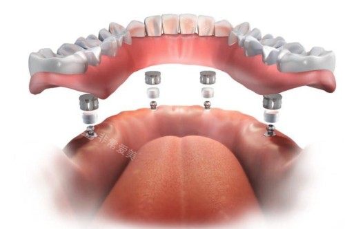 all-on-4种植模型图