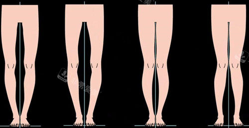 不同腿型卡通示意图 不同腿型卡通示意图