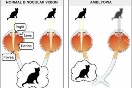 正常眼与弱视眼视物对比图