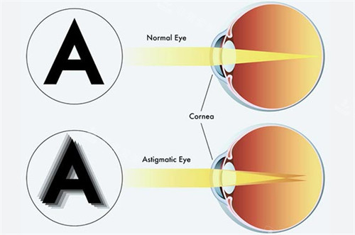 正常眼睛和弱视眼睛成像不同
