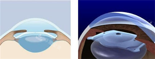 ICLV5晶体植入位置