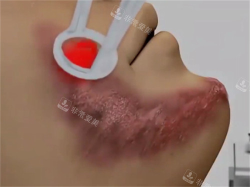 激光去疤的流程