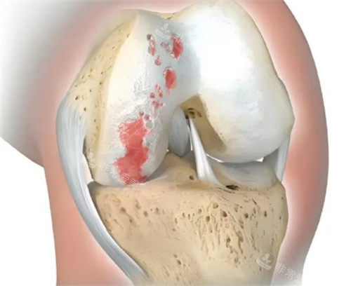 膝盖性关节炎照片