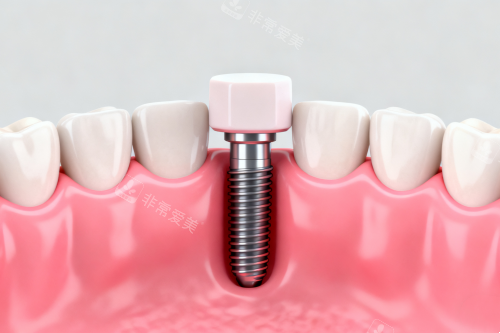 种植牙植入口腔模型图