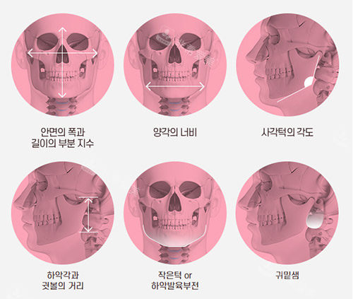 面部轮廓手术示意图 面部轮廓手术示意图