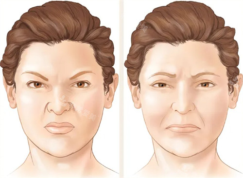 韩国改善法令纹咋样？精准填充+细腻手法，前后对比惊艳，体验感舒适又安心！