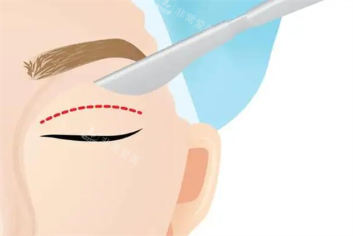 割雙眼皮示意圖