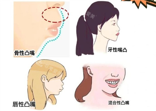 不同类型的凸嘴