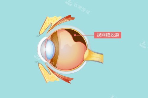 视网膜脱落图片展示