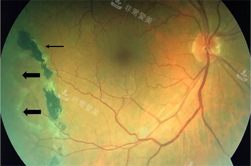 视网膜劈裂演示图