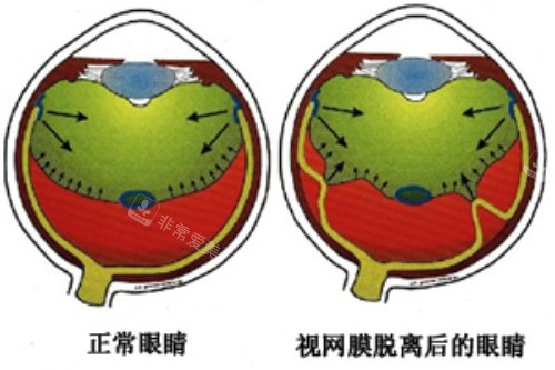 视网膜脱落卡通对比图