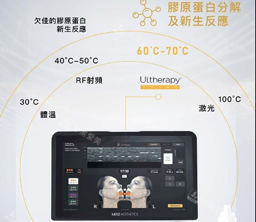 美版超声刀二代