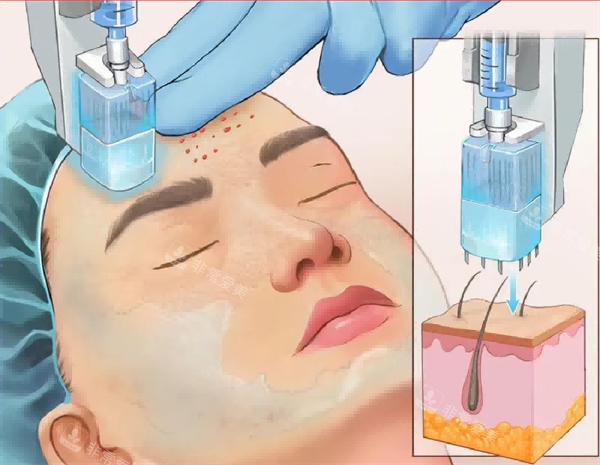 真人分享韩国医美水光类价格参考：丽珠兰黑盒2cc28W韩币，JUVELLOK1cc才8.5W韩币超友好！