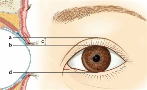 PARK法双眼皮素材