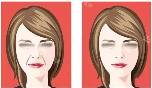 韓國醫美法令紋價格：唔使幾千蚊？填平凹陷位大攻略！