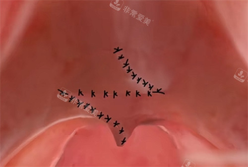 腭裂修复手术的缝合形状