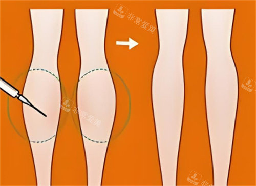 小腿吸脂前后对比