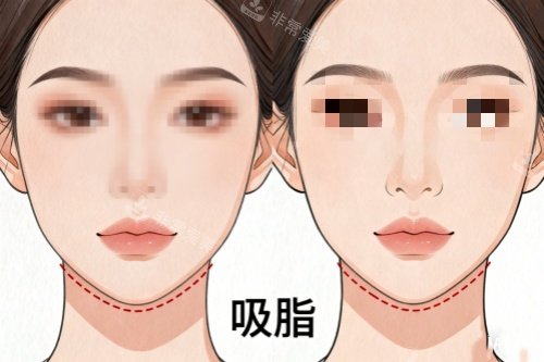 下巴做吸脂前后对比图
