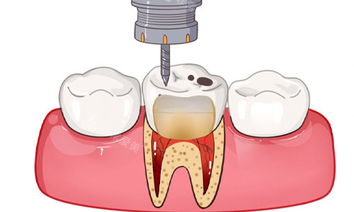 清除牙齿龋坏部分展示