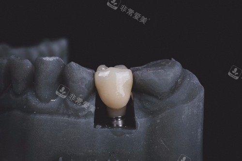 牙齿修复示意图