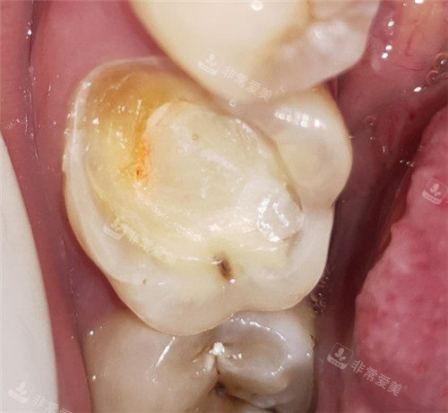 牙齿龋坏清理图