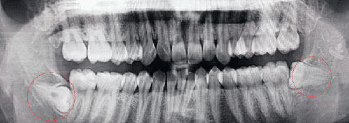 智齿牙片示意图