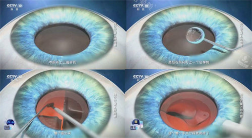 白内障手术流程简图