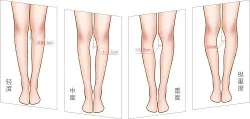 腿型矫正对比图