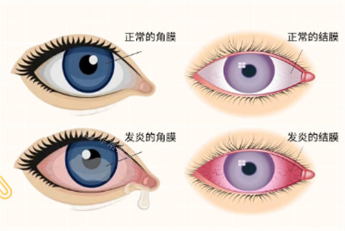 角膜炎和结膜炎分别症状