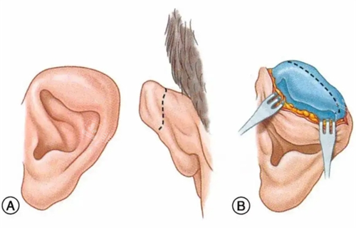 周勇院长耳再造手术：无需植皮全包法|2期完成耳廓重建|昆明耳畸形修复优选
