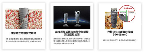 卡尔斯种植牙有什么不同