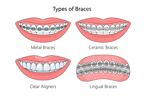 牙齿矫正的不同类型