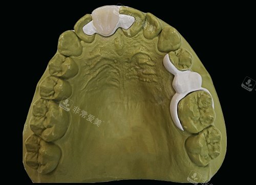 hpp粘接桥牙齿口腔内示意图