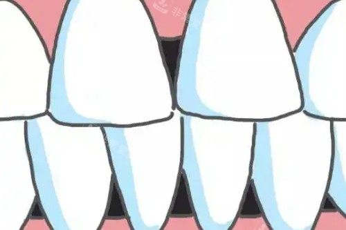 牙齿黑三角卡通图