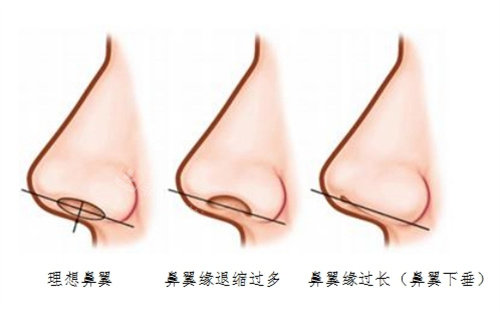 鼻翼退缩矫正术图片实例