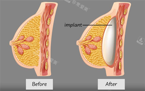 假體隆胸植入的層次