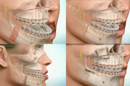 双鄂手术卡通图