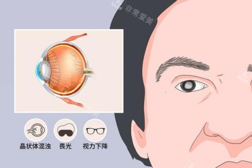 白内障症状卡通图