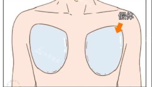 男生假体丰胸示意图