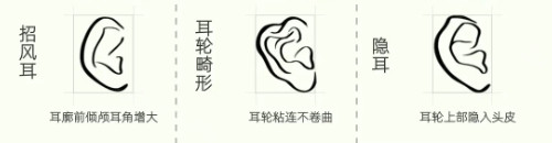 耳畸形种类
