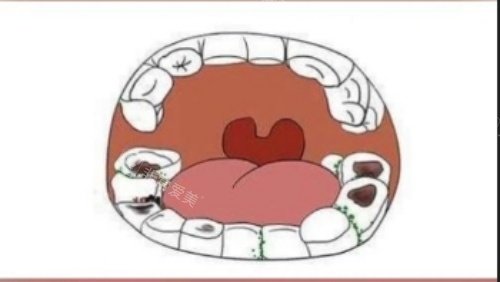 牙齿腐蚀漫画示意图